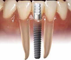 зубні імплантанти