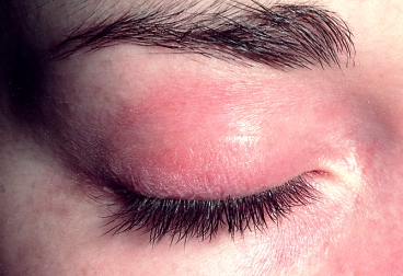 аллергический отек глаза