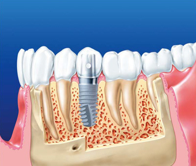 имплантанты зубов