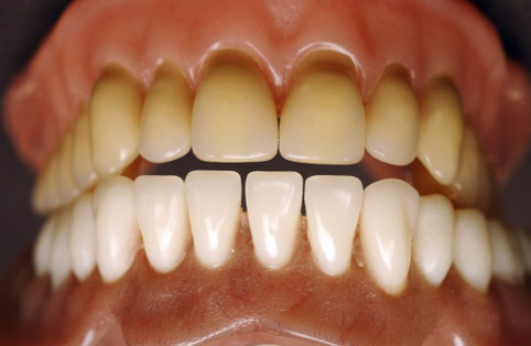 болезни зубов