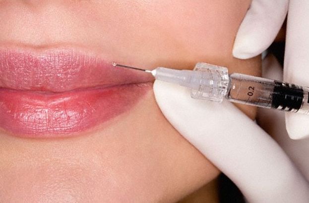 Коррекция губ гиалуроновой кислотой