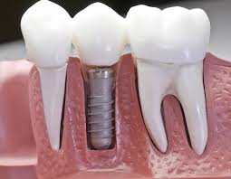 Зубные имланты