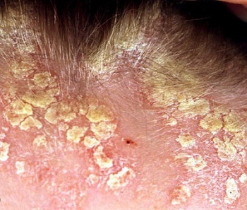 Заболевание и лечения кожи головы