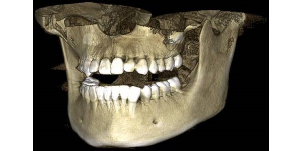 3D-снимок зубов 