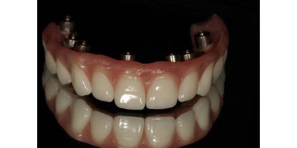 імплантації зубів