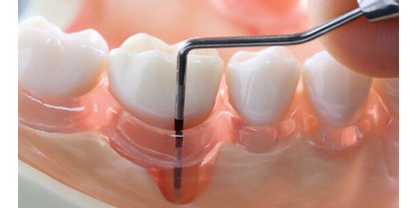 Лікування зубів і ясен