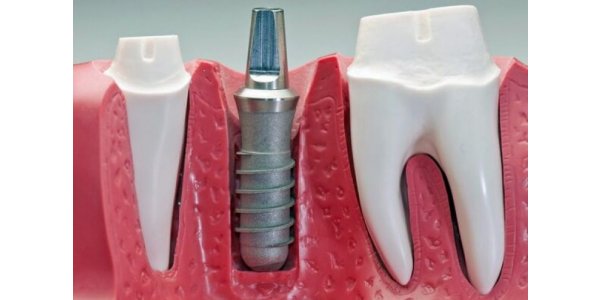 импланты стоматологические