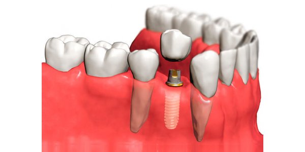 имплантация зубов 