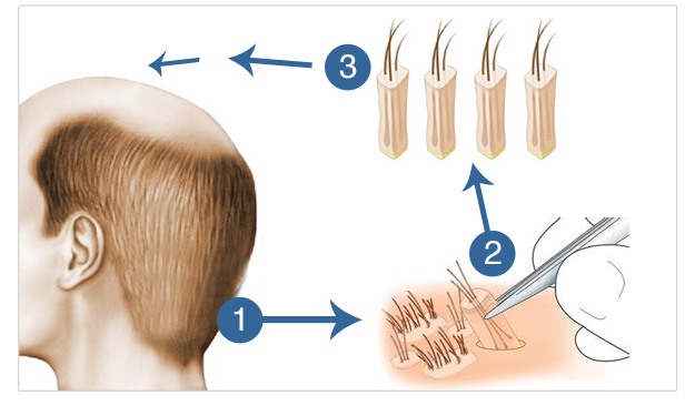 Бесшовный метод пересадки волос