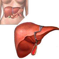 Chronic cholecystitis, cholangitis. 