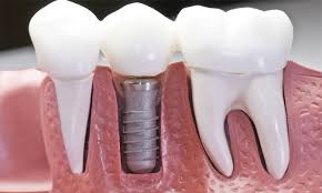 Имплантация зубов: что она собой представляет