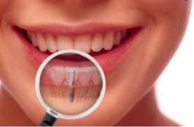 імплантація зубов