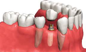 зубний імплантат