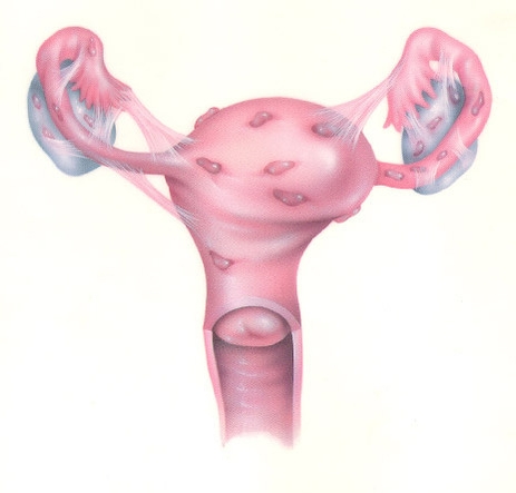 эндометриоз яичников