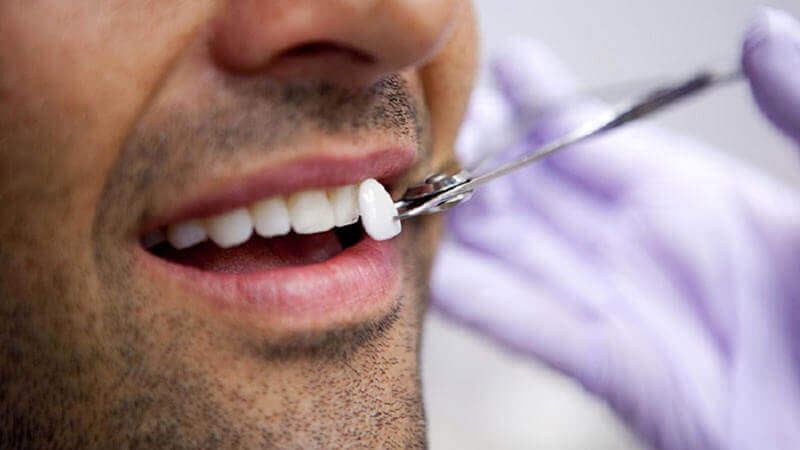 встановлення вінірів на переді зуби