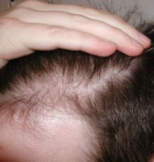 alopecia, hair, hair loss